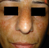 ملاسما - Melasma