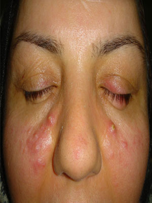 Rosacea