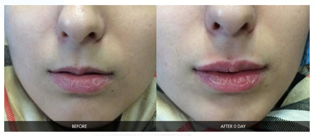 Fillers