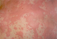 Hives (Urticaria)